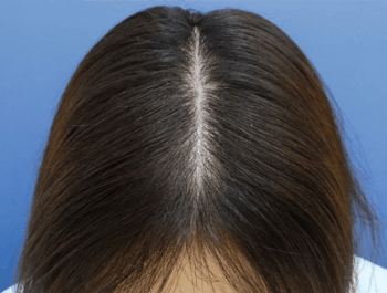 女性の薄毛症例集 公式 クレアージュ 女性薄毛治療の専門クリニック
