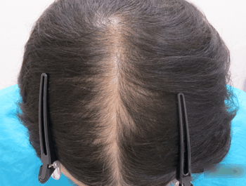 女性の薄毛症例集 公式 クレアージュ 女性薄毛治療の専門クリニック