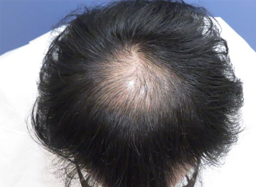 薄毛タイプ：M型 年齢：48歳 職業：自営 治療期間：1年