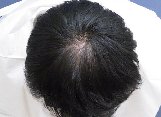 薄毛タイプ：M型 年齢：48歳 職業：自営 治療期間：1年