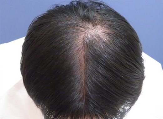 薄毛タイプ：M型 年齢：40歳 職業：会社員 治療期間：1年
