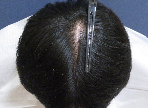 薄毛タイプ：M型 年齢：40歳 職業：会社員 治療期間：1年