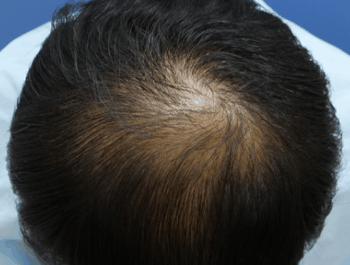 薄毛タイプ：O型 年齢：34歳 職業：公務員 治療期間：1年