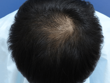 薄毛タイプ：O型 年齢：34歳 職業：公務員 治療期間：1年