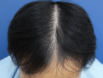 薄毛タイプ：MO型 年齢：30歳 職業：会社員 治療期間：1年