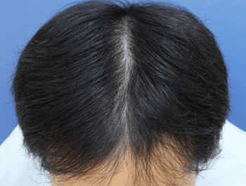 薄毛タイプ：MO型 年齢：30歳 職業：会社員 治療期間：1年