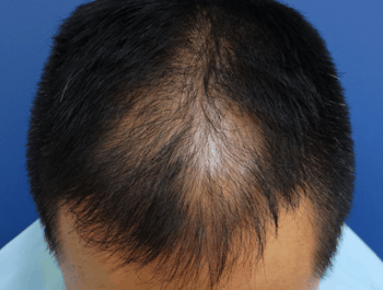薄毛タイプ：MO型 年齢：39歳 職業：会社員 治療期間：1年