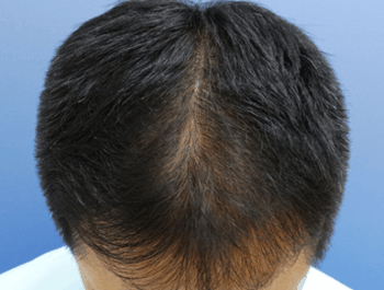 薄毛タイプ：MO型 年齢：39歳 職業：会社員 治療期間：1年