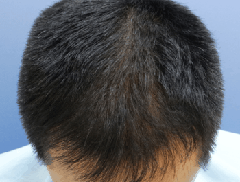 薄毛タイプ：MO型 年齢：39歳 職業：会社員 治療期間：1年