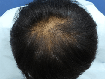 薄毛タイプ：O型 年齢：39歳 職業：公務員 治療期間：1年