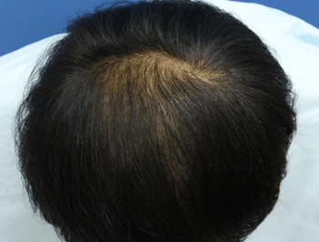 薄毛タイプ：O型 年齢：39歳 職業：公務員 治療期間：1年