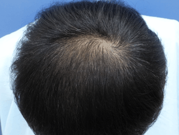 薄毛タイプ：O型 年齢：39歳 職業：公務員 治療期間：1年