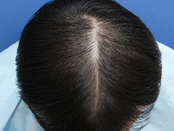 薄毛タイプ：O型 年齢：33歳 職業：会社員 治療期間：1年