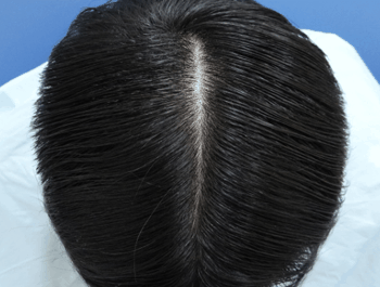 薄毛タイプ：O型 年齢：33歳 職業：会社員 治療期間：1年