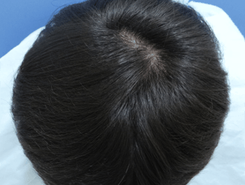 薄毛タイプ：O型 年齢：37歳 職業：会社員 治療期間：1年