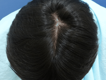 薄毛タイプ：O型 年齢：37歳 職業：会社員 治療期間：1年