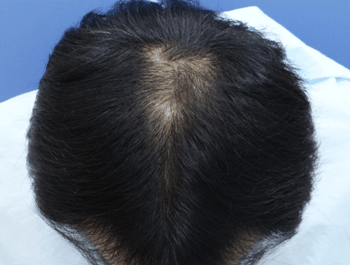 薄毛タイプ：O型 年齢：36歳 職業：会社員 治療期間：1年