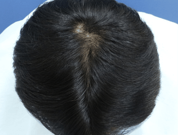 薄毛タイプ：O型 年齢：36歳 職業：会社員 治療期間：1年