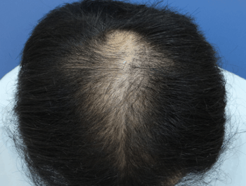 薄毛タイプ：O型 年齢：38歳 職業：会社員　 治療期間：1年