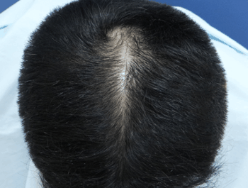 薄毛タイプ：O型 年齢：38歳 職業：会社員　 治療期間：1年