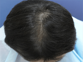 薄毛タイプ：O型 年齢：36歳 職業：会社員 治療期間：1年