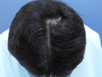 薄毛タイプ：O型 年齢：36歳 職業：会社員 治療期間：1年