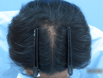 薄毛タイプ：O型 年齢：30歳 職業：会社員 治療期間：1年