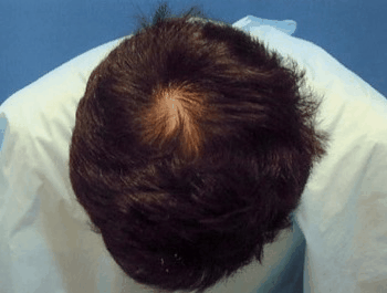 薄毛タイプ：O型 年齢：34歳 職業：自営業 治療期間：1年