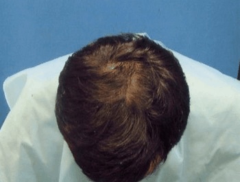 薄毛タイプ：O型 年齢：34歳 職業：自営業 治療期間：1年