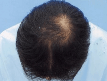 薄毛タイプ：MO型 年齢：34歳 職業：会社員 治療期間：1年