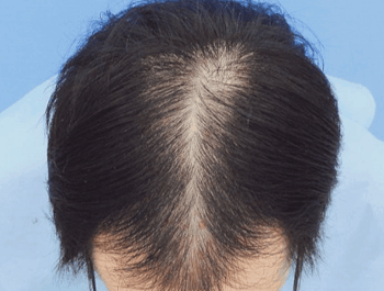 薄毛タイプ：MO型 年齢：35歳 職業：自営業 治療期間：1年