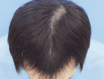 薄毛タイプ：MO型 年齢：35歳 職業：自営業 治療期間：1年