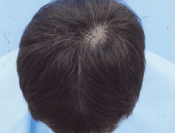薄毛タイプ：MO型 年齢：35歳 職業：自営業 治療期間：1年