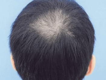 薄毛タイプ：O型 年齢：35歳 職業：会社員 治療期間：1年