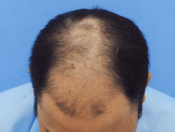 薄毛タイプ：MO型 年齢：34歳 職業：郵便配達 治療期間：1年