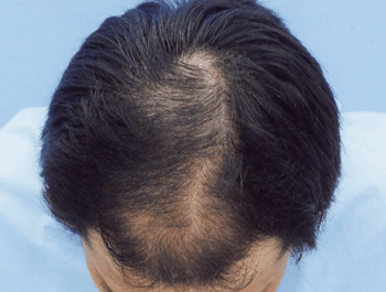 薄毛タイプ：MO型 年齢：34歳 職業：郵便配達 治療期間：1年