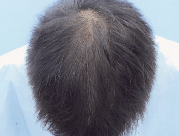 薄毛タイプ：O型 年齢：31歳 職業：会社員 治療期間：1年