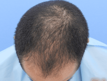 薄毛タイプ：MO型 年齢：36歳 職業：自営 治療期間：1年