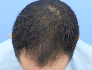 薄毛タイプ：MO型 年齢：36歳 職業：自営 治療期間：1年