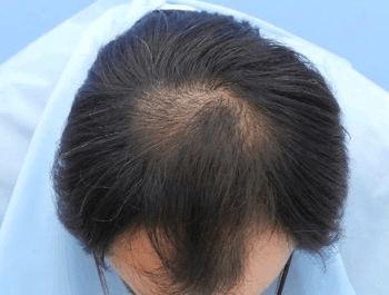 薄毛タイプ：O型 年齢：37歳 職業：会社員 治療期間：1年