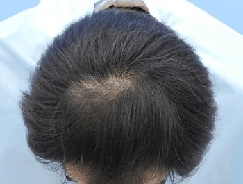 薄毛タイプ：O型 年齢：37歳 職業：会社員 治療期間：1年