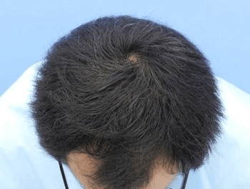 薄毛タイプ：O型 年齢：37歳 職業：会社員 治療期間：1年