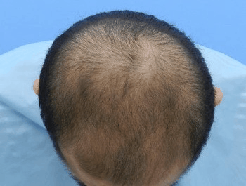 薄毛タイプ：MO型 年齢：36歳 職業：会社役員 治療期間：1年