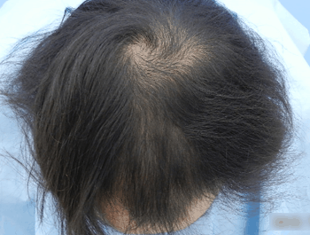 薄毛タイプ：MO型 年齢：34歳 職業：会社員 治療期間：1年