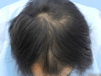 薄毛タイプ：MO型 年齢：34歳 職業：会社員 治療期間：1年