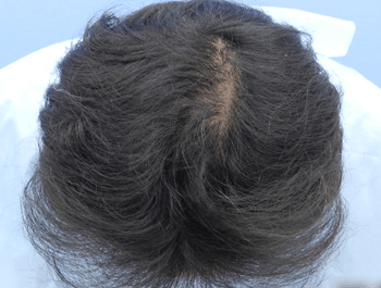 薄毛タイプ：O型 年齢：38歳 職業：設計事務所 治療期間：1年