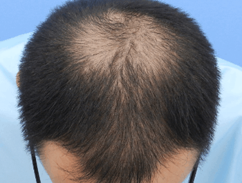 薄毛タイプ：O型 年齢：38歳 職業：会社員 治療期間：1年