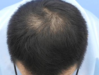 薄毛タイプ：O型 年齢：38歳 職業：会社員 治療期間：1年