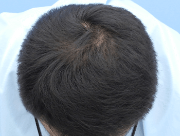 薄毛タイプ：O型 年齢：38歳 職業：会社員 治療期間：1年