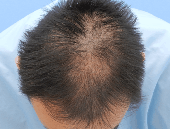 薄毛タイプ：O型 年齢：38歳 職業：事務職 治療期間：1年